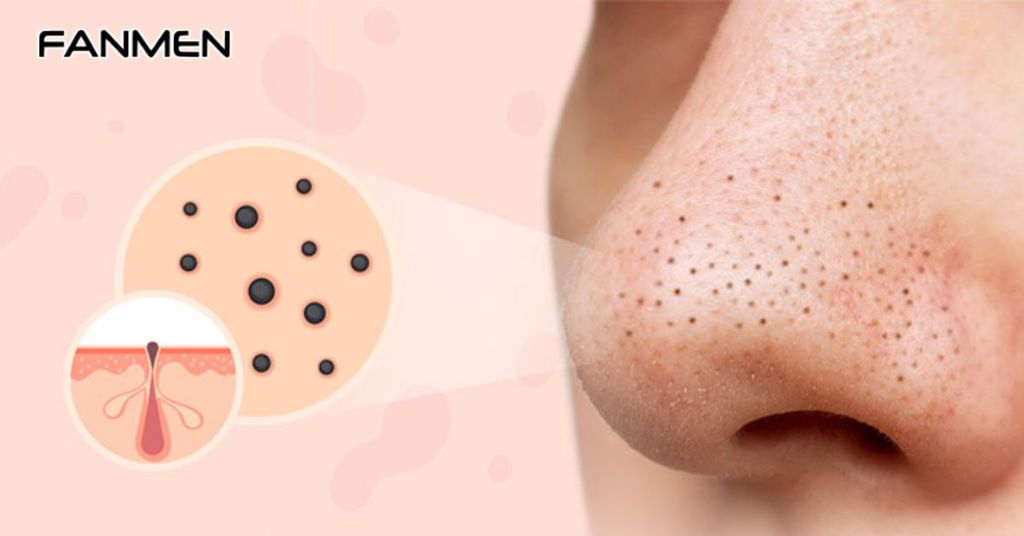 Tác Hại Của Mụn Đầu Đen Lâu Năm