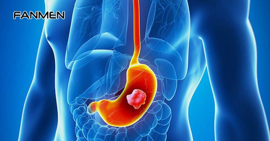 Bệnh trào ngược dịch mật