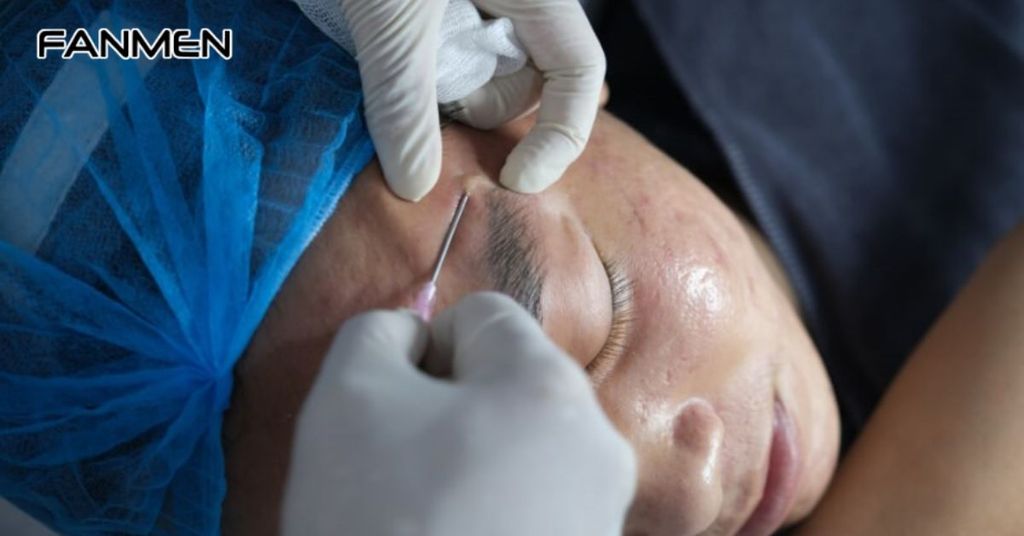 Điều trị sẹo với phương pháp bóc tách sẹo