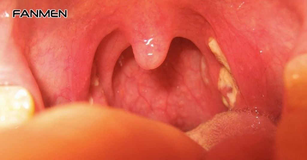 Triệu Chứng Của Cục Bã Đậu Gây Hôi Miệng