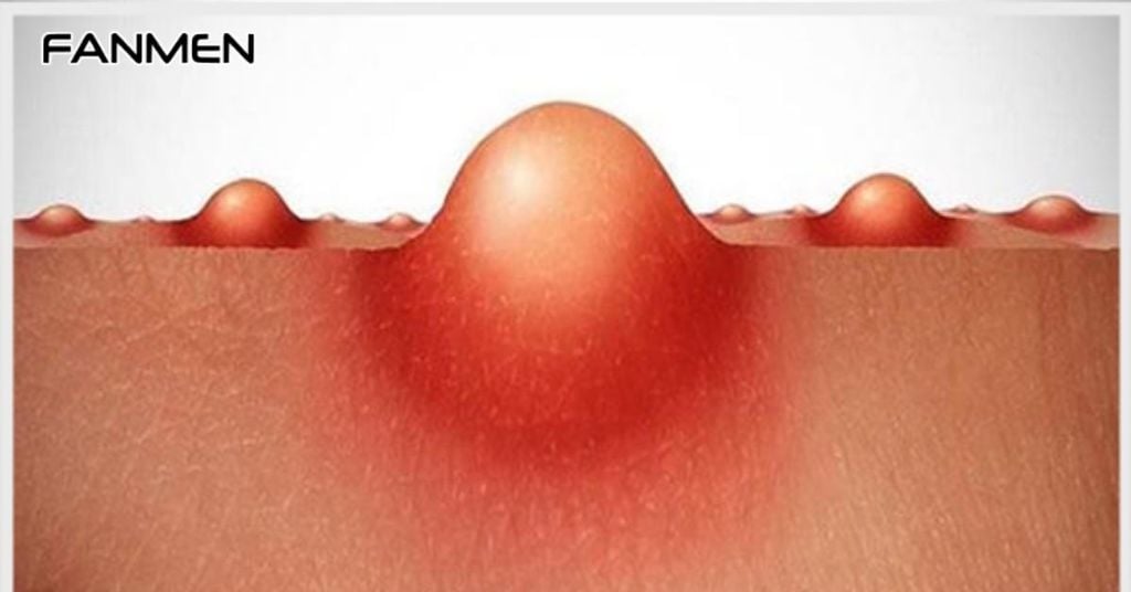 Cách Điều Trị Mọc Mụn Bọc Ở Vùng Kín Nam Giới