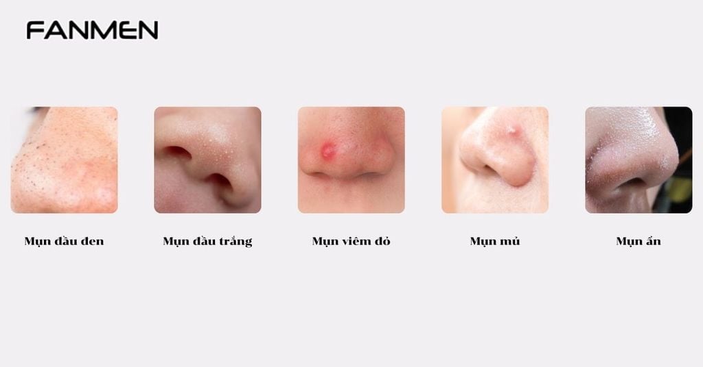 Các Loại Mụn Thường Mọc 2 Bên Cánh Mũi Nam Giới