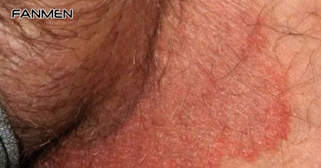 Nguyên Nhân Gây Ra Hắc Lào Vùng Kín Nam