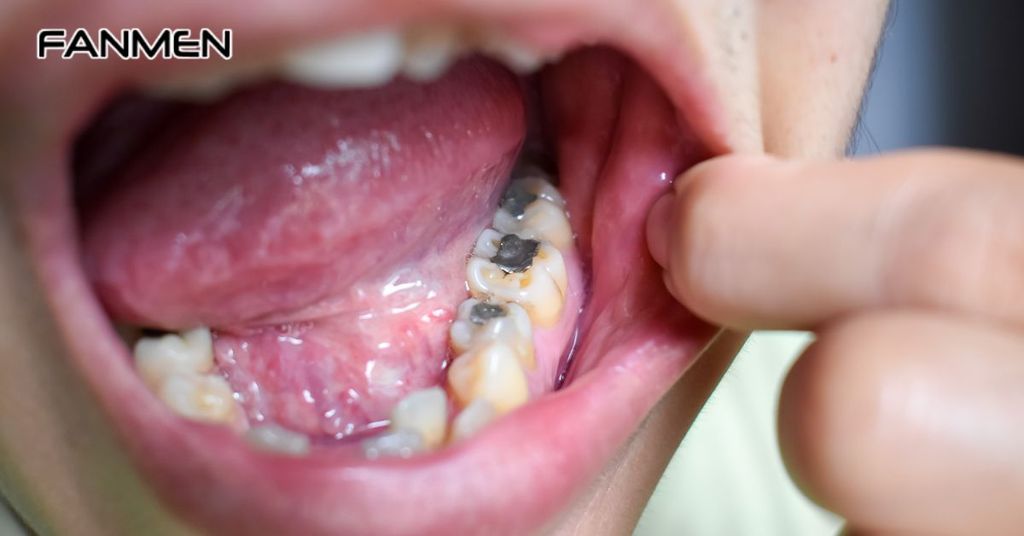 Do vệ sinh răng miệng không kỹ lưỡng