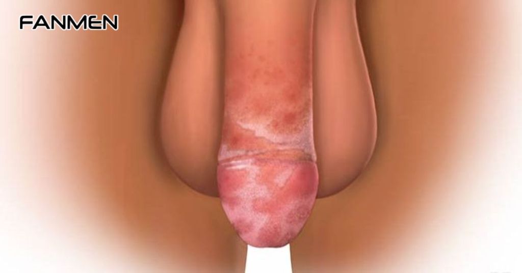 Viêm bao quy đầu