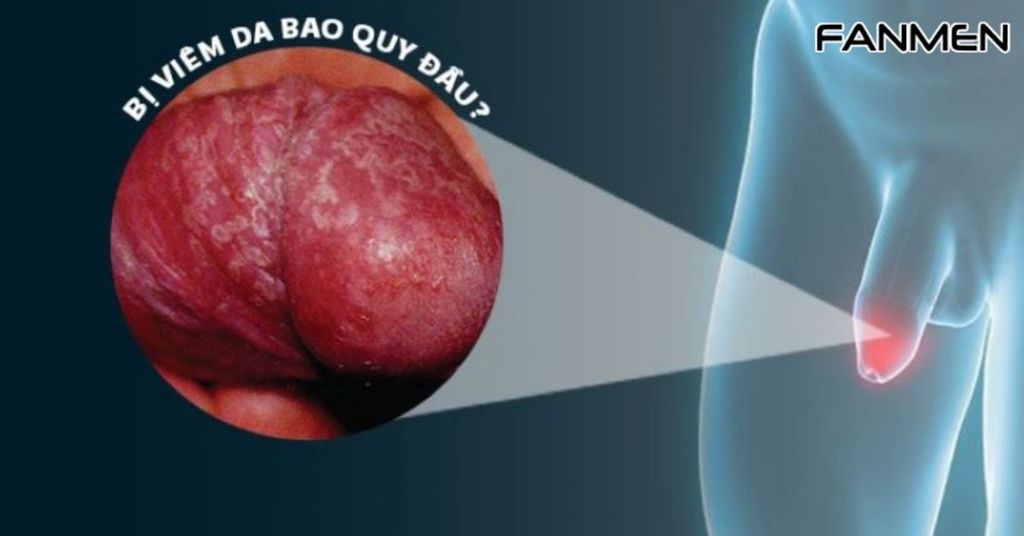 Viêm bao quy đầu