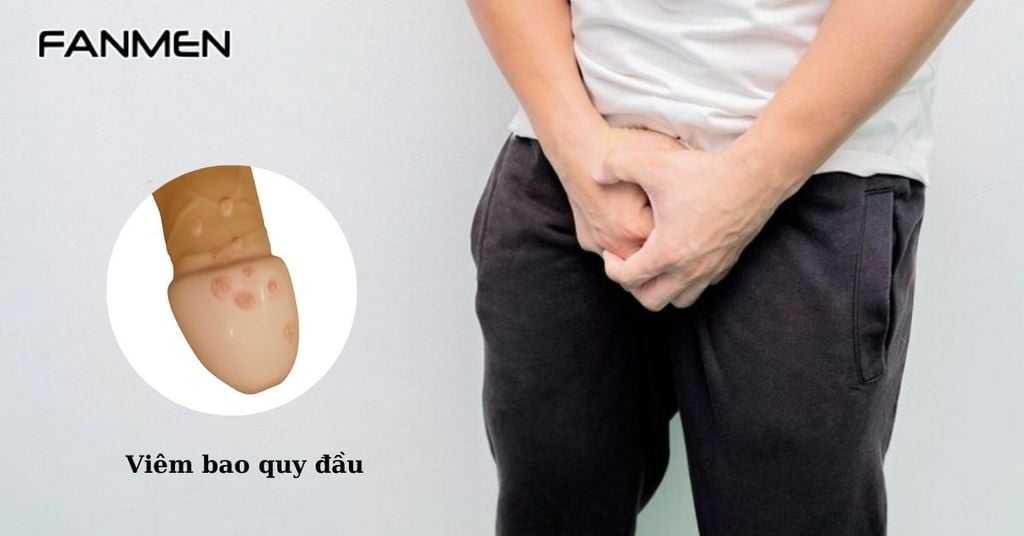 Mọc mụn ở vùng kín nam giới do viêm bao quy đầu
