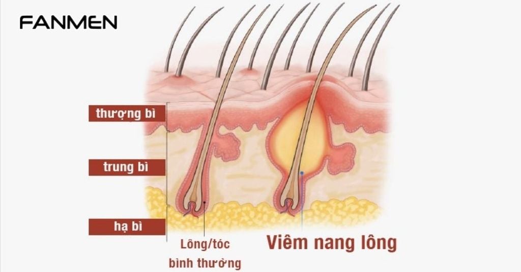 Viêm Chân Lông Vùng Kín Ở Nam Là Gì?