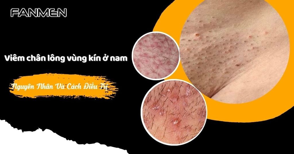 Viêm chân lông vùng kín ở nam