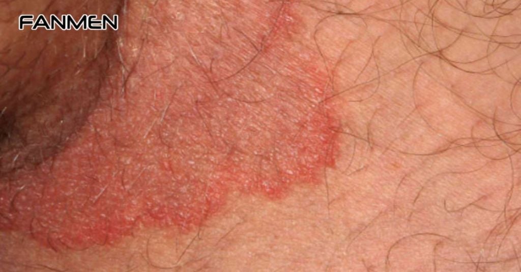 Viêm da tiếp xúc