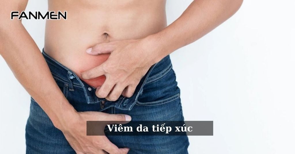 Viêm da tiếp xúc