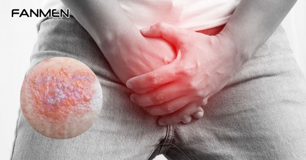 Viêm da tiếp xúc