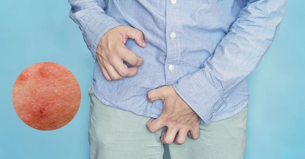 Dương vật nổi mụn đỏ do viêm da tiếp xúc