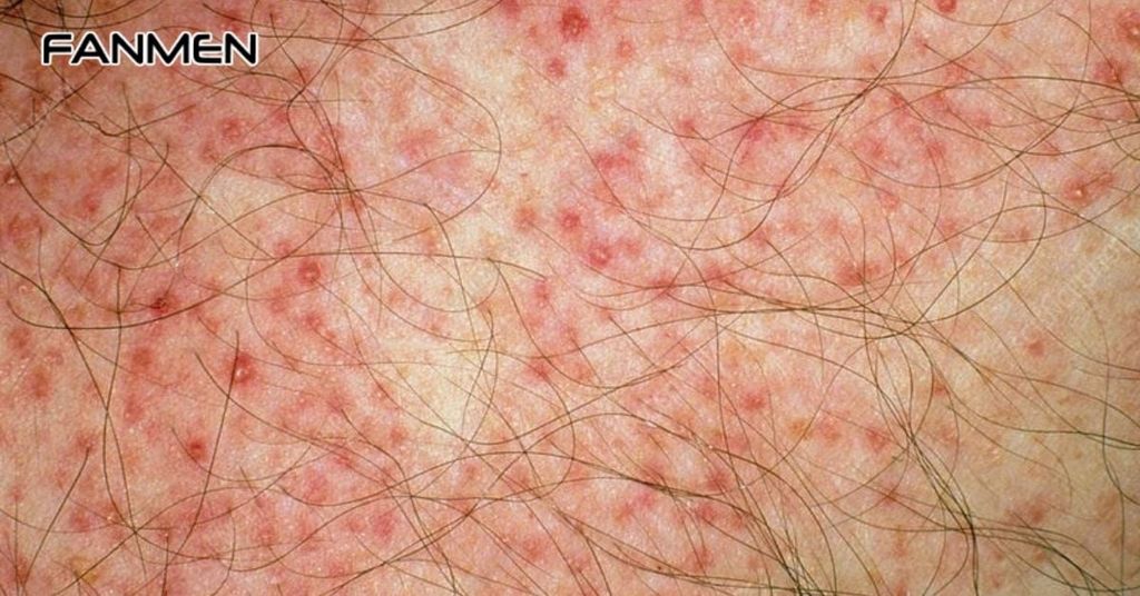 Mọc mụn nước ở vùng kín nam giới do viêm nang lông